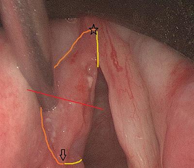 Transoral Laser Microsurgery (TLM) for Glottic Cancer: Prospective Assessment of a New Pathology Workup Protocol
